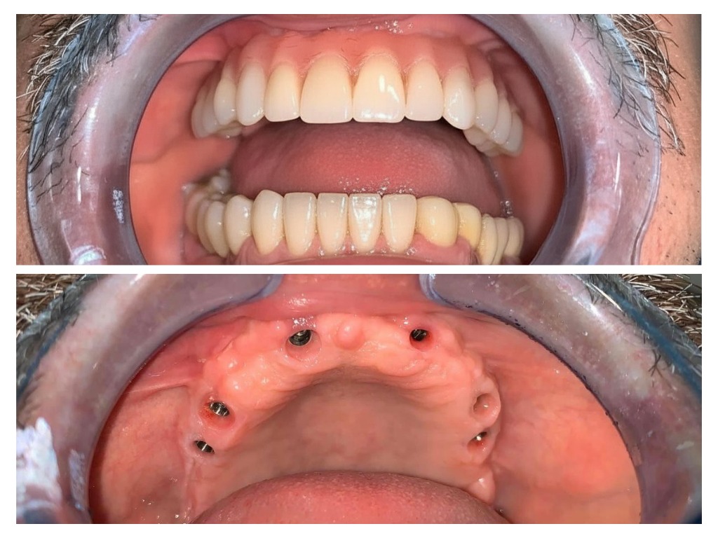 Implant dentar — rezultat real